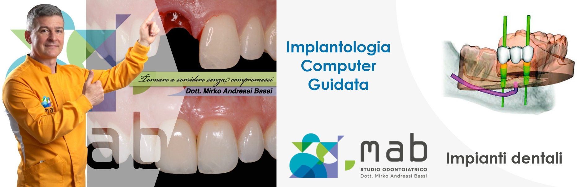 implantologia computer guidata studio dentistico dr mirko andreasi bassi