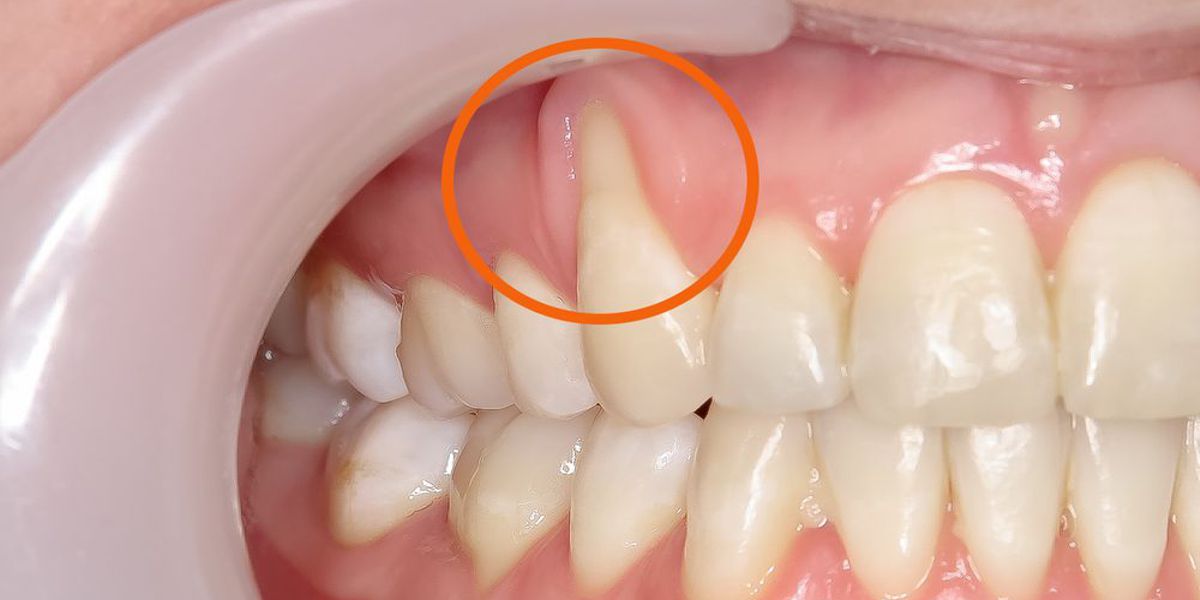 Variazioni morfologiche delle gengive: